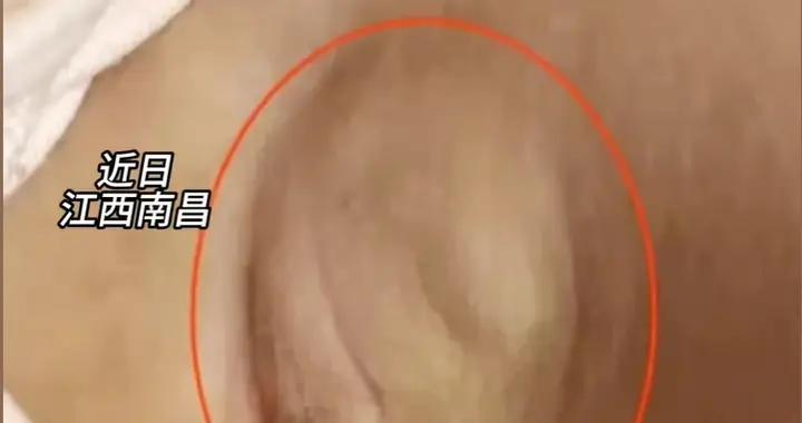 孩子弄破體溫針致腋下長腫塊，醫生說要手術！爲啥吞水銀反不用治