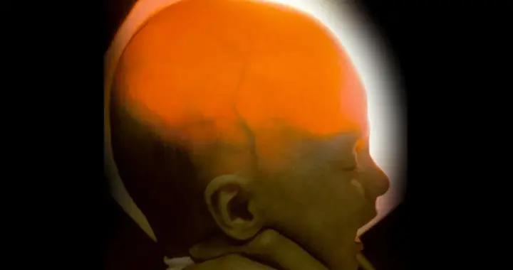 頭顱裏只剩一勺“粉色果凍”，她卻活到了20歲，沒有腦子也能活下去？