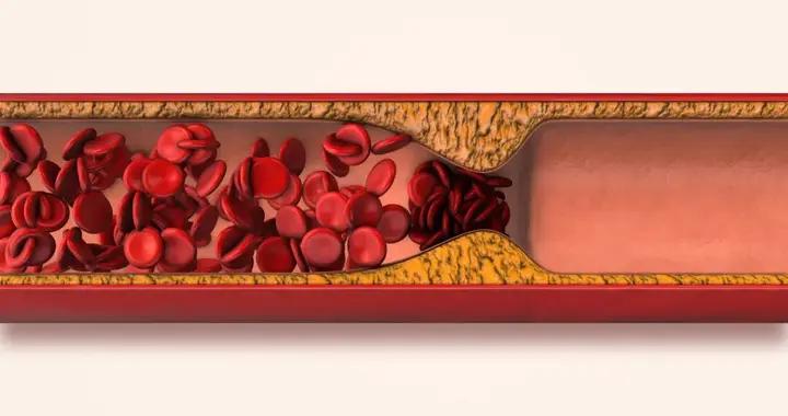 你的血管正在悄悄長斑變硬！這樣做，“斑塊”可能縮小甚至消失…