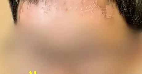 男孩玩哈利波特魔杖不慎爆炸，滿臉雙手燙傷毀容，醫生爲啥誇他