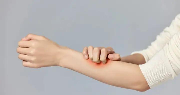 到了冬季“呼呼”掉皮，中醫幫你解決冬季皮炎困擾