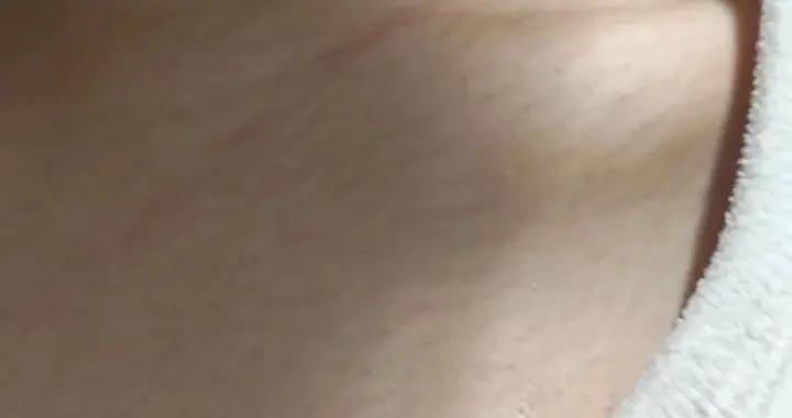 真的想問：脖子上一條條的“黑道道”，是胰島素抵抗嗎？