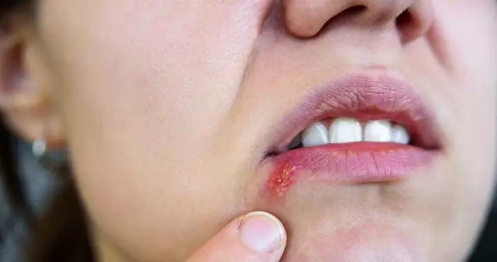 陝西一女子，嘴角長了小水泡後腦死亡！醫生：這不是上火