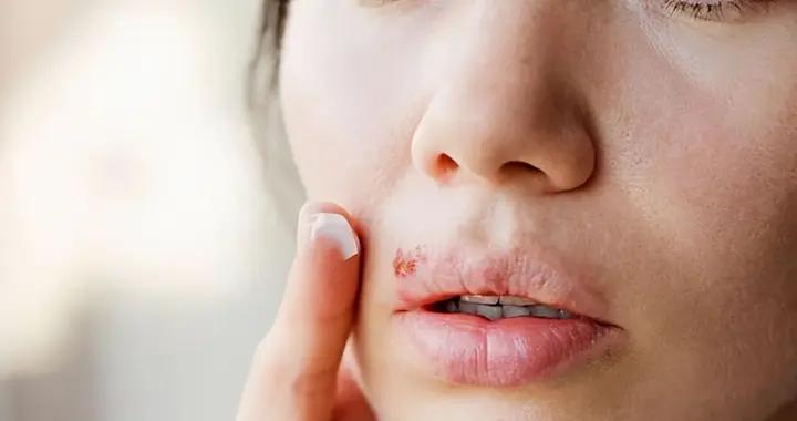 嘴上起水泡不是“上火”！小心是這種終身潛伏的病毒！會傳染！