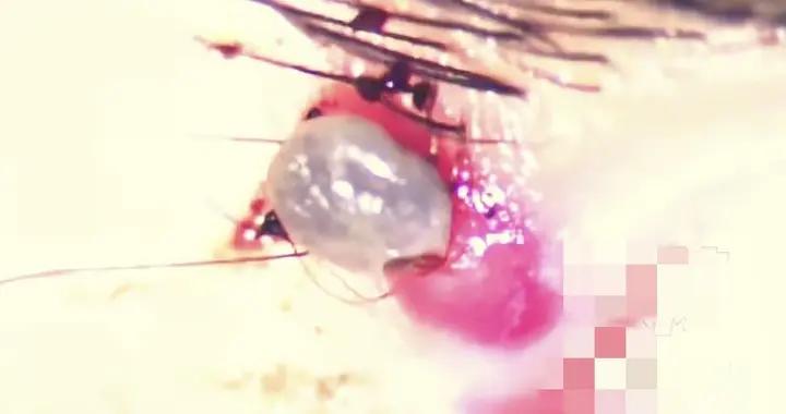 海南旅遊後蜱蟲鑽進孩子眼瞼，醫生：千萬別亂拔，嚴重可致命