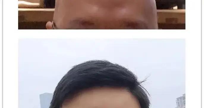 一塊紅燒肉把我送上手術檯，切了肺，又切了膽