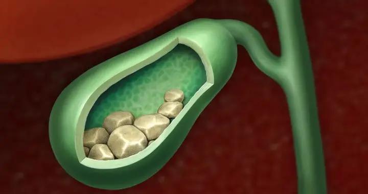 膽囊結石越小就越安全？