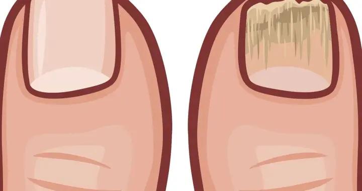 指甲變色、增厚？別不當回事！全面解讀“甲癬”的防與治