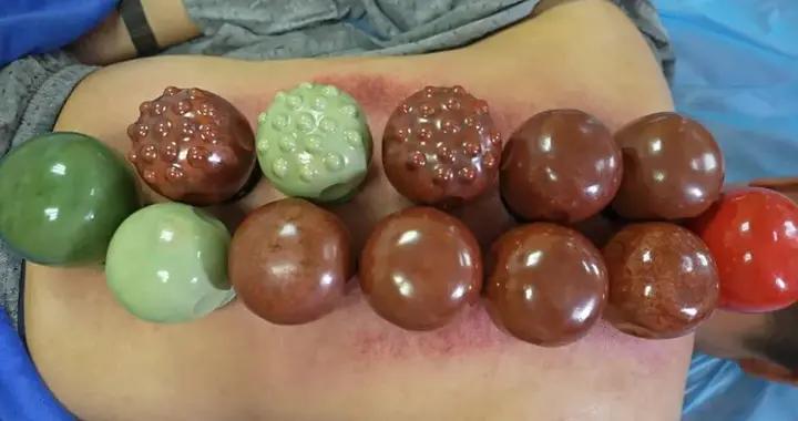 神奇中醫療法丨陶土平衡火罐