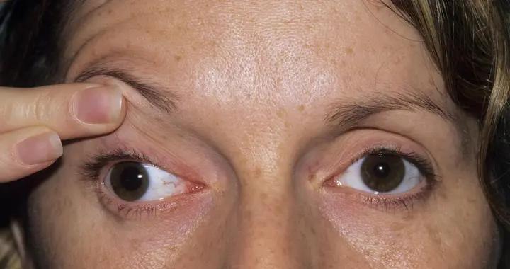 眼皮總跳不停？別大意！可能是身體在“提示”你，快來瞧瞧