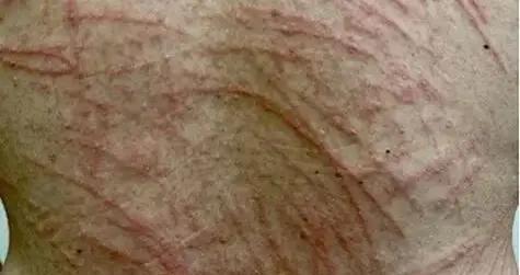 背上莫名出現“鞭痕”16年，每次都跟這種蘑菇有關……