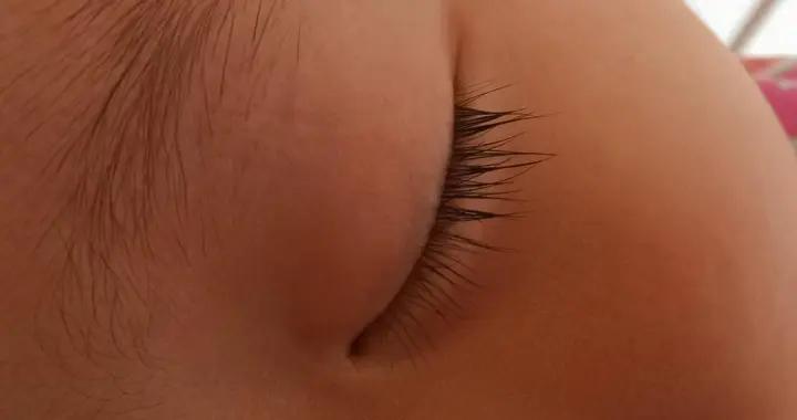 寶寶眼周小紅點藏隱患？從常見到特殊情況，家長該這樣應對