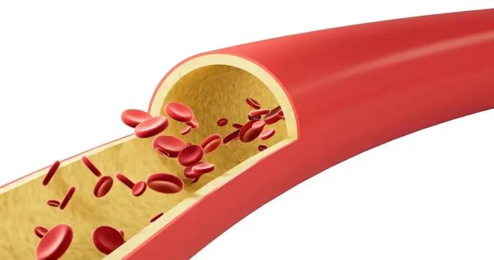 只要不“頭痛”“頭暈”，高血壓就不嚴重？大錯特錯！