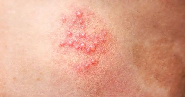 人不會平白無故患帶狀皰疹！醫生強調：得帶狀皰疹，多半有4共性