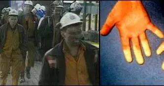 1999年英國礦工獲賠5億英鎊，只因他們的手指變了個顏色