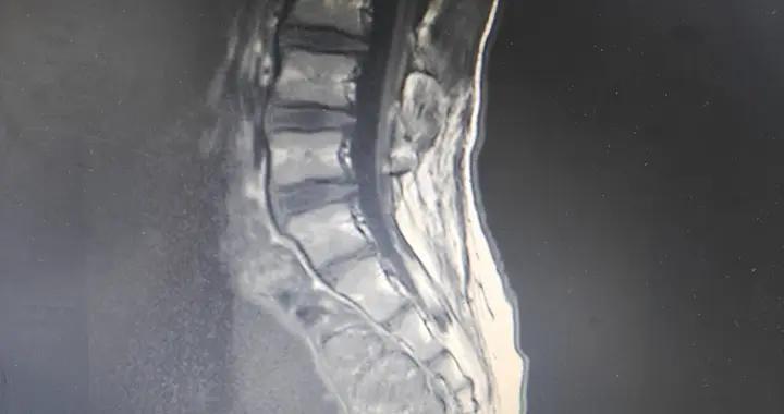 脊柱裂專欄-第38期（ 椎管內脂肪堆積再發）