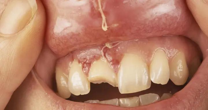 不刷牙=害自己！牙齒爛掉只是開始，全身健康都可能受牽連