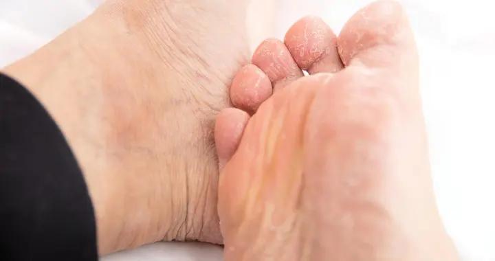 腳臭影響社交？這些小妙招超管用！快速恢復清爽