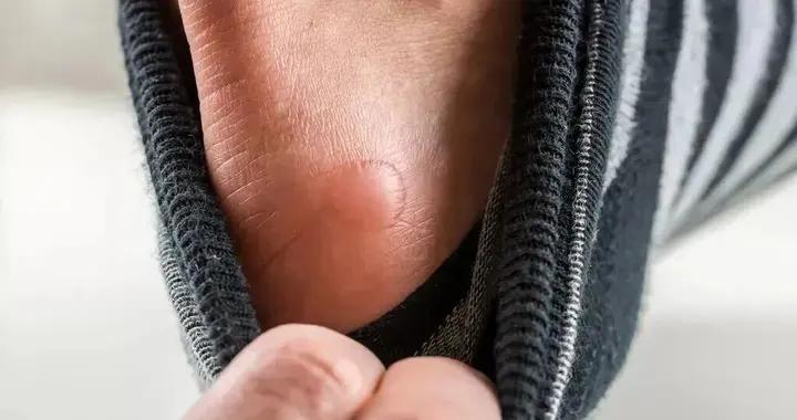 腳上磨起了大水泡，要不要挑破？不小心破了會怎麼樣？