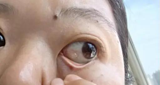 水泡有什麼稀奇的？但我的水泡怎麼長在眼球上