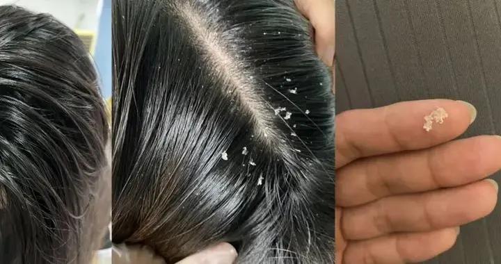 住手！頭皮上長了這樣的“小顆粒”，摳了只是一時爽......