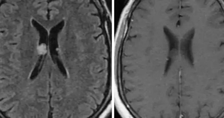 寶爸寶媽科普：寶寶查出室管膜下囊腫、腦積水別慌張