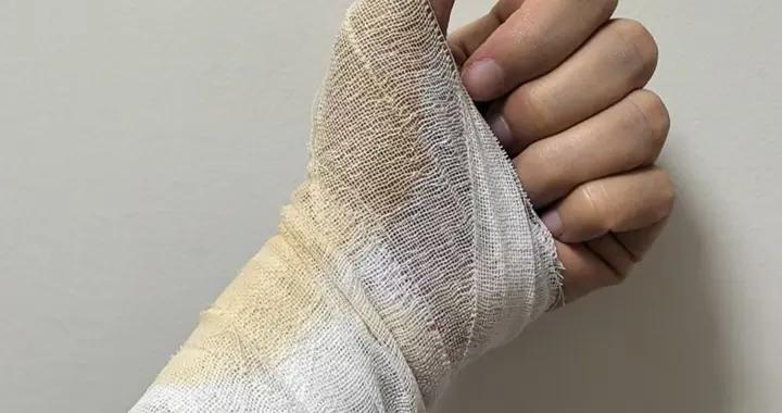 小心隱翅蟲！手腕上的透明小泡連成了片，醫生說幸好沒弄到眼睛裏