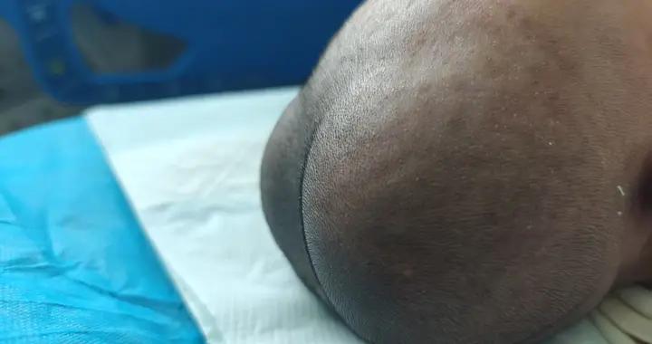 頭皮血腫，家長別慌一個“包”，兩種來路