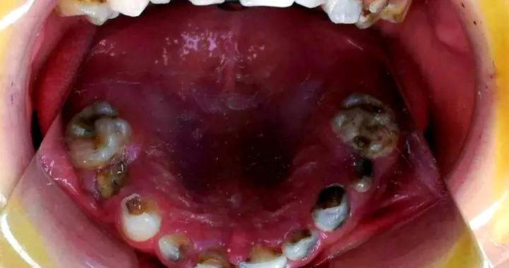 孩子滿嘴“爛牙”，並不是因爲喫糖，家長的4個行爲纔是罪魁禍首