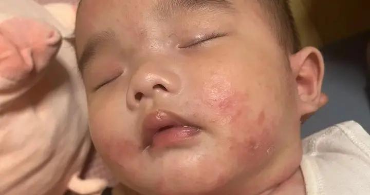 媽媽的一碗寶寶面，差點要了兒子的命！醫生：食物排敏很重要
