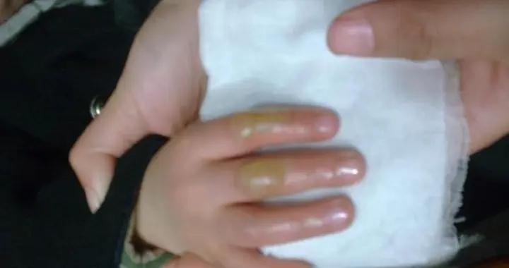 孩子被100度熱湯燙傷，媽媽60分鐘5字急救很有效，醫生點贊