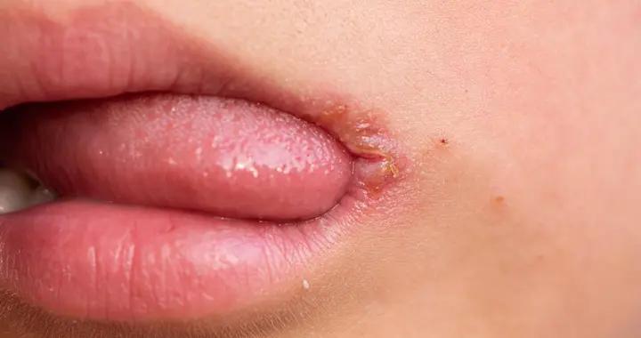 告別嘴角發黑！從生活習慣到疾病排查，簡單幾招嘴角恢復正常膚色