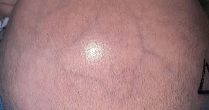 腦積水專欄-第36期（回顧重度腦積水治療病例分享）