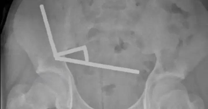 菜刀插進胸膛8年竟渾然不知，這位狠人震驚了醫學界