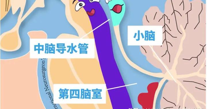 腦積水專欄-第37期（孤立性四腦室知識分享）