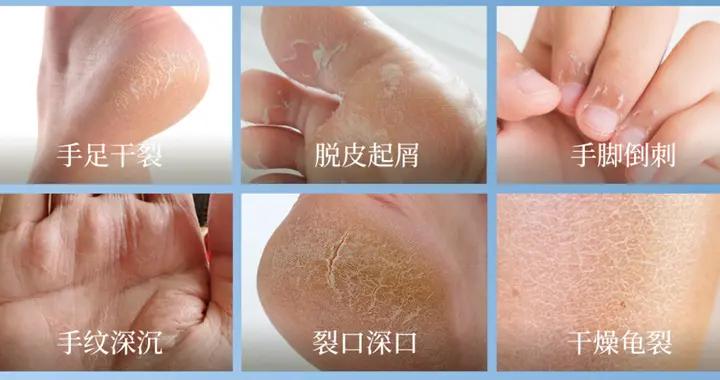 小腿“魚鱗紋”、手腳乾裂脫皮？別以爲是缺水，小心是......