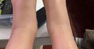 兩週內，我37碼的腳腫到只能穿40碼的鞋