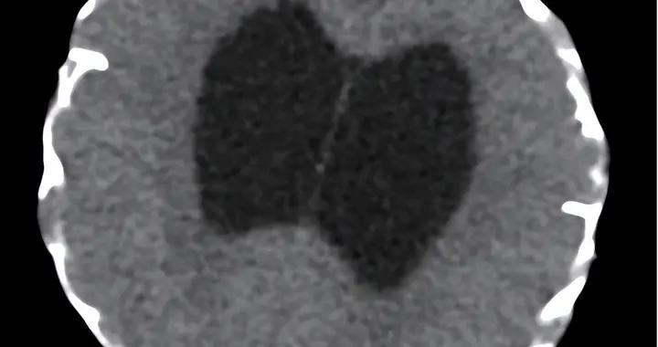 顱縫早閉專欄-第41期（人字縫早閉病歷分享）