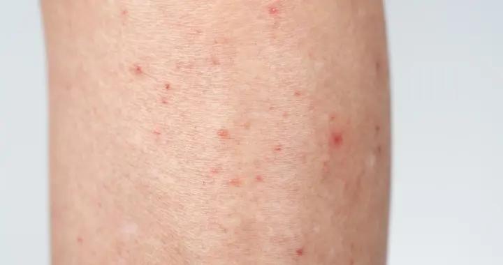 溼疹不治療能自愈嗎？不同情況答案不同