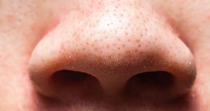 告別草莓鼻！縮小鼻子毛孔的祕密武器，從清潔到生活習慣全攻略