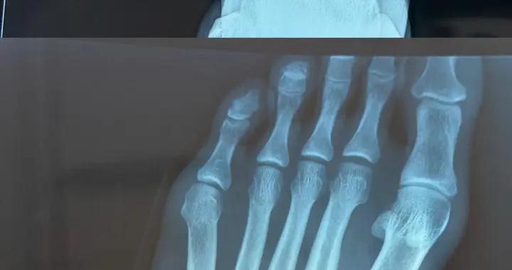 何宇鵬分享摘除左腳鋼板照：終於要和這個“鐵哥們”說再見了