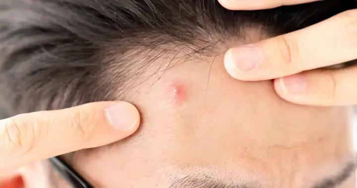 青春痘只發生在青春期？