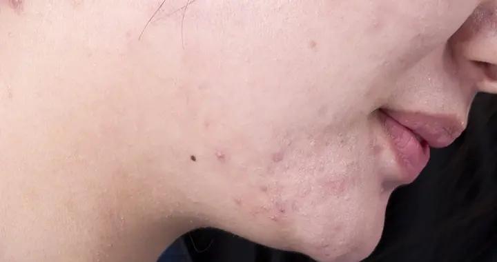 女生有小鬍子正常嗎？從遺傳到疾病，揪出元兇，還你光滑脣周