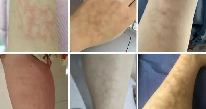 冬天一覺醒來，身上出現“蟒蛇紋”！萬萬沒想到，常見的它們都有風險