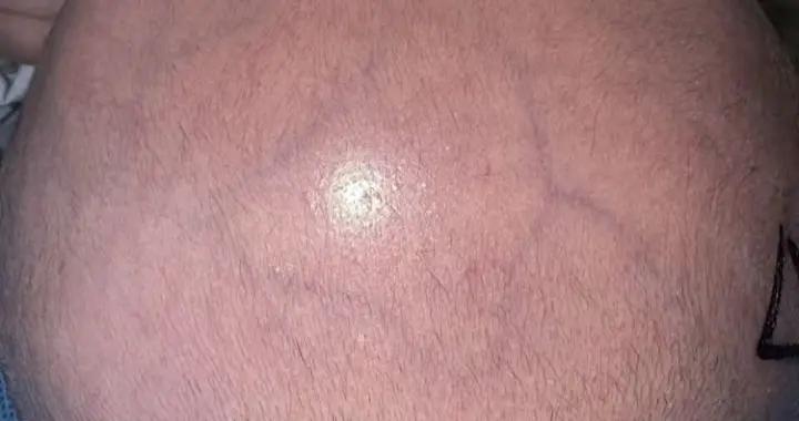 腦積水專欄-第38期（巨大頭圍病歷分享）